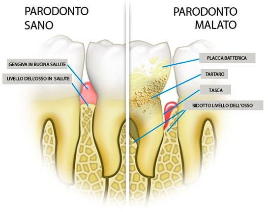 foto-parodontite