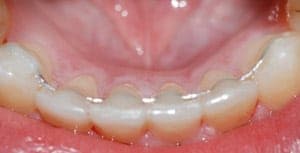 https://studioreglia.com/wp-content/uploads/2020/12/stabilità-ortodontica.jpg
