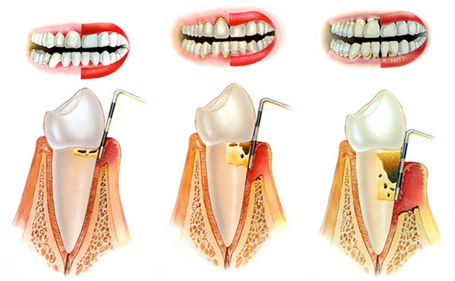 parodonto dentale
